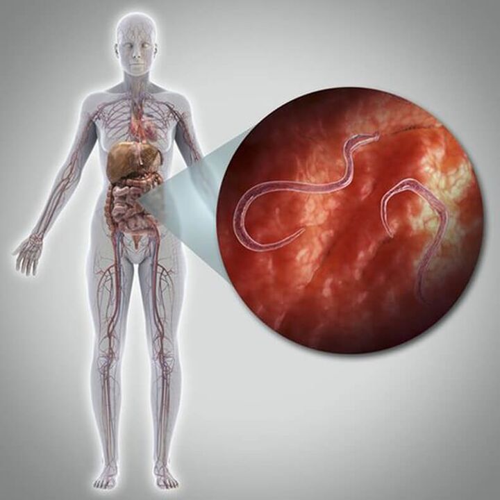 Parasites dans le corps d'une personne